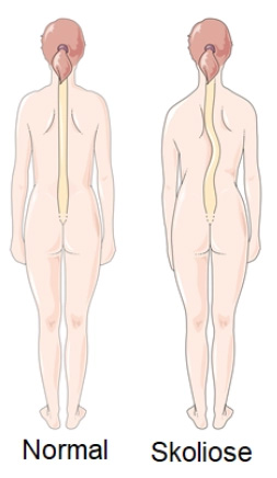 Brystrygsmerter - ArosKiropraktor