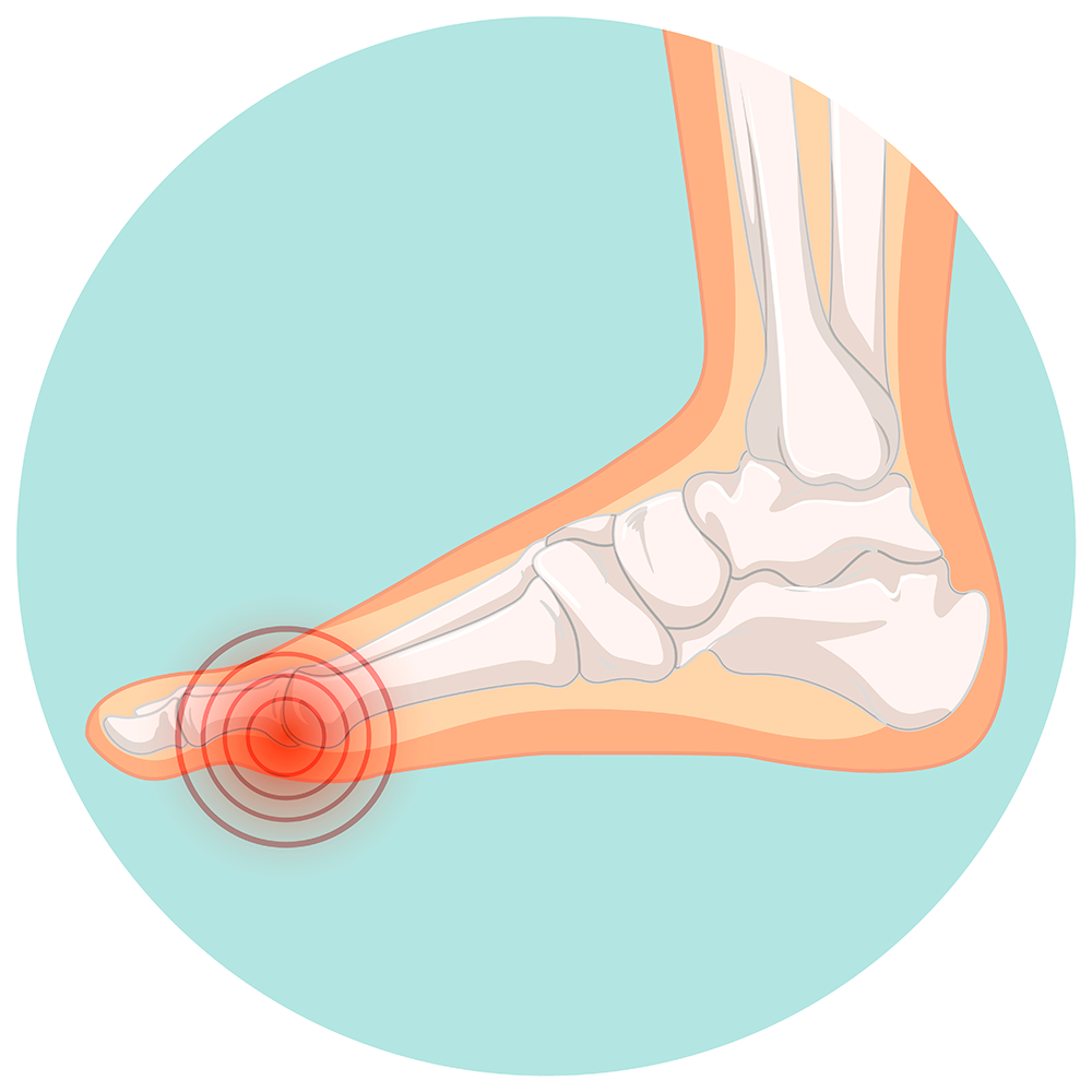Fodsmerter - ArosKiropraktor
