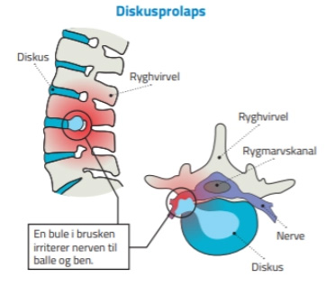Diskusprolaps - ArosKiropraktor