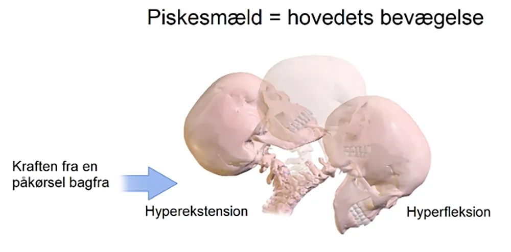 Piskesmæld - ArosKiropraktor