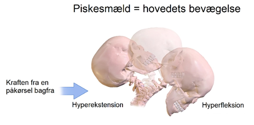 Piskesmæld - ArosKiropraktor