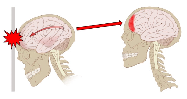 Hjernerystelse - ArosKiropraktor