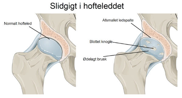 Hoftesmerter - ArosKiropraktor
