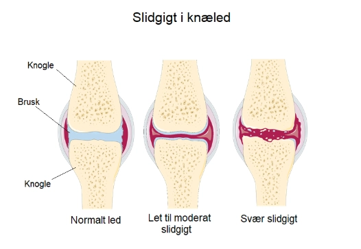 Slidgigt i knæled - ArosKiropraktor